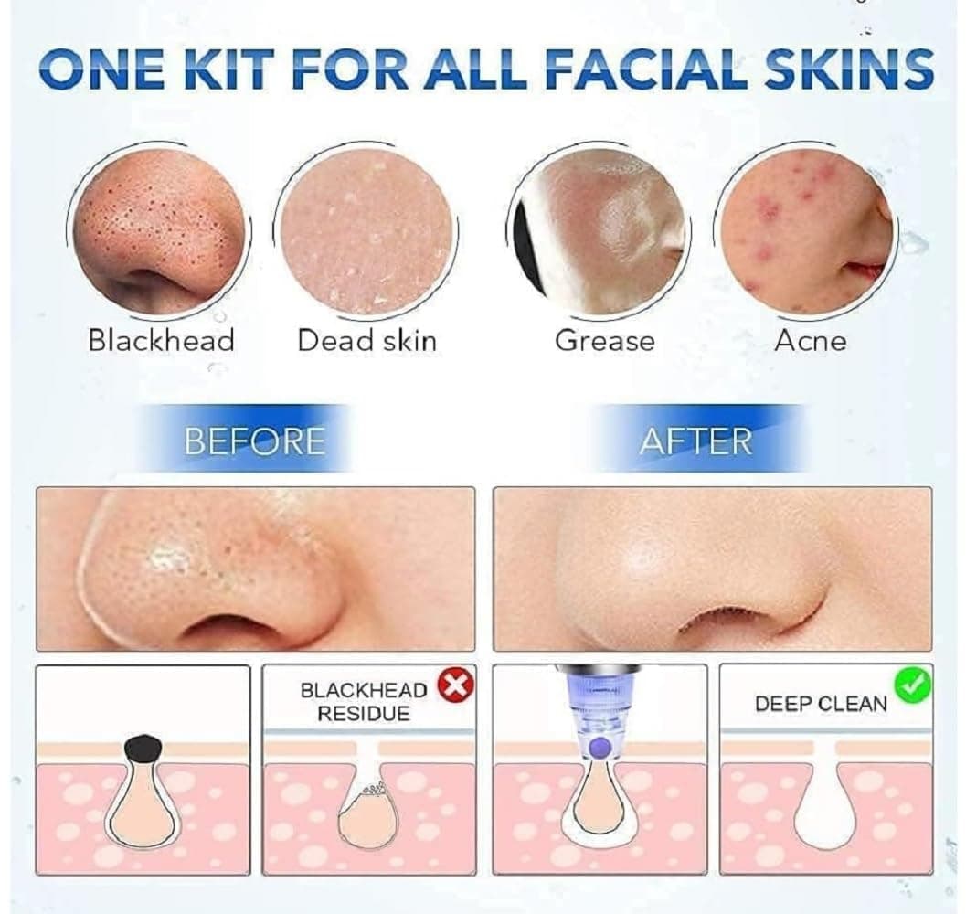 4-in-1 Blackhead Remover